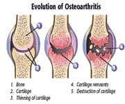 Osteoarthritis-type